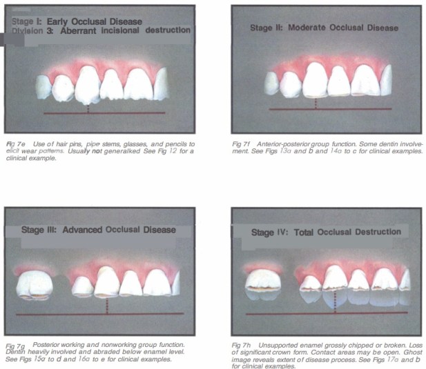 Int J Periodont Rest Dent 1990 Vol.10-4