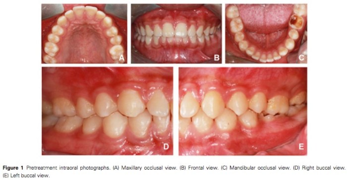 J Prosthodontics 2015 Vol.24-2