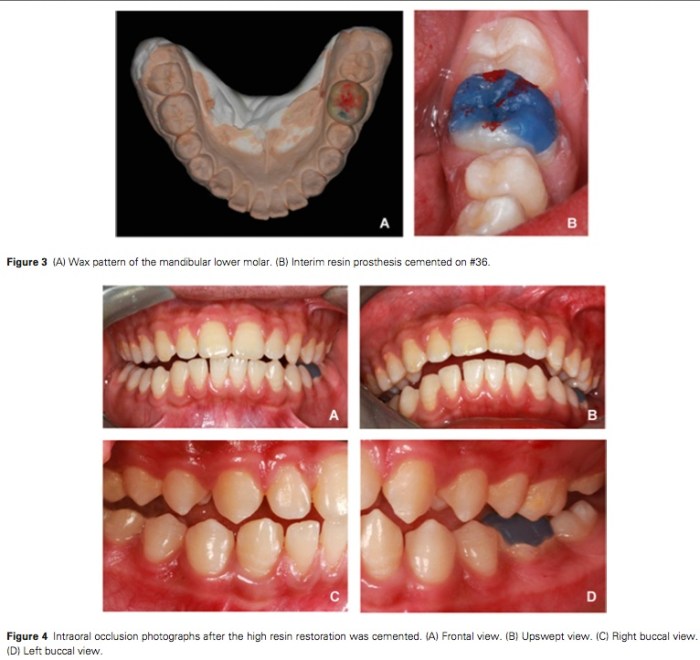 J Prosthodontics 2015 Vol.24-3
