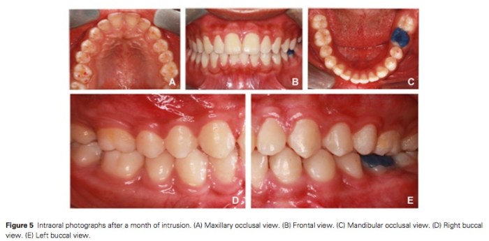 J Prosthodontics 2015 Vol.24-4