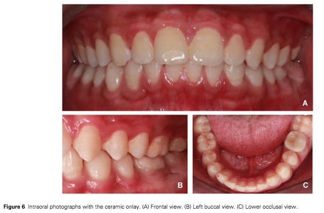 J Prosthodontics 2015 Vol.24-5