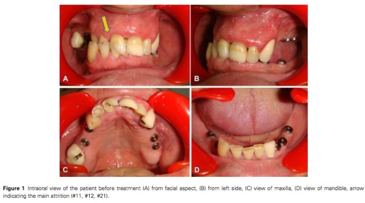 J Prosthodontics 2015 Vol.24-2