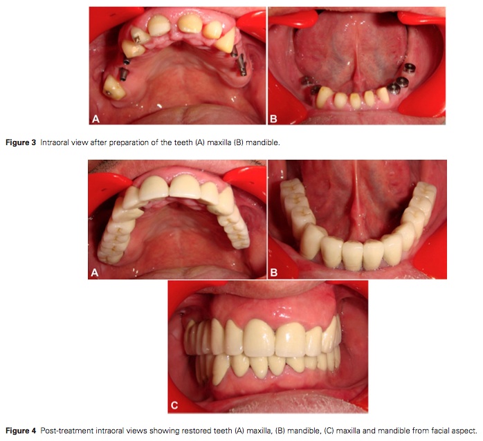 J Prosthodontics 2015 Vol.24-4