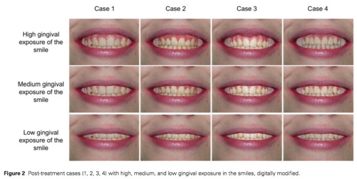 J Prosthodontics 2015 Vol.24-3