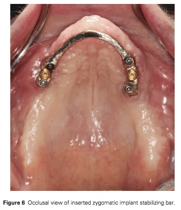 J prosthodontics 2015 Vol.24-5