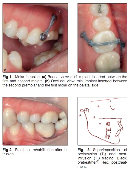 Int J Prosthodont 2015 Vol.28-2