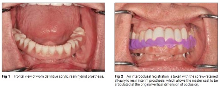 Int J Prosthodont 2016 Vol.29-2