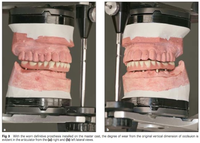 Int J Prosthodont 2016 Vol.29-3