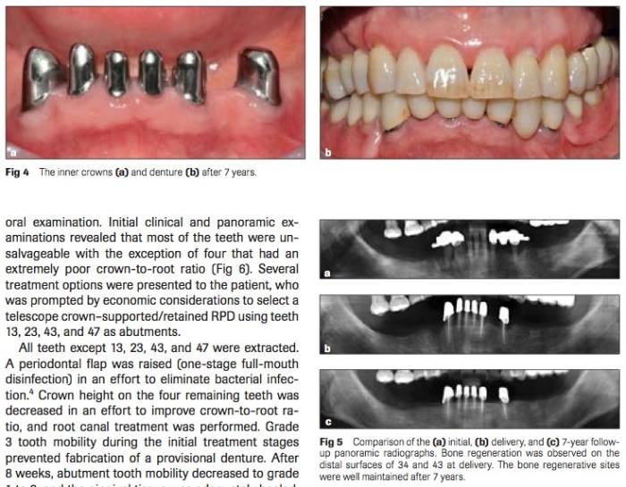 Int J Prosthodont 2016 Vol.29-4