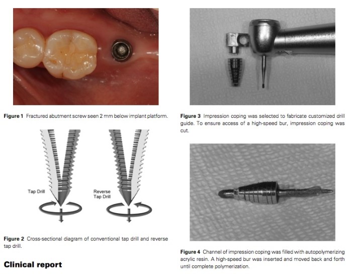 J Prosthodontics 2016 Vol.25-2