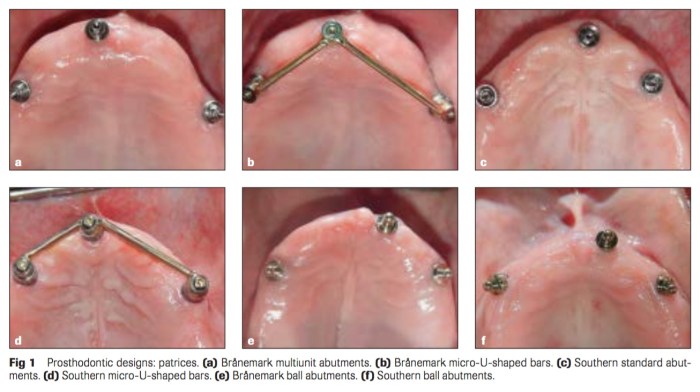 Int J Prosthodont 2016 Vol.29-2