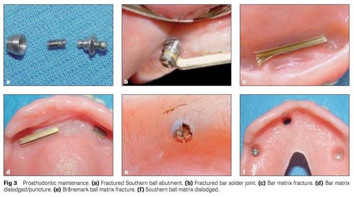 Int J Prosthodont 2016 Vol.29-4