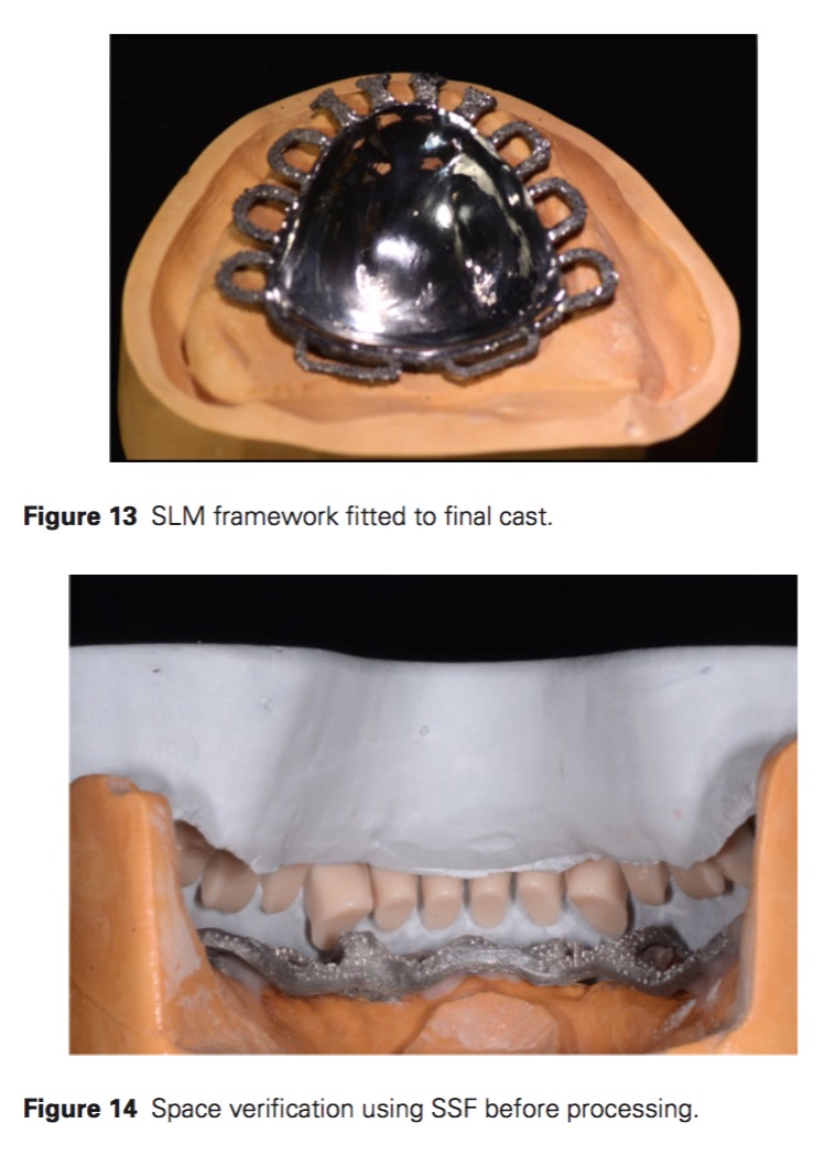 使用CAD/CAM onlay增強denture teeth的強度—Afify(2016) | yehc
