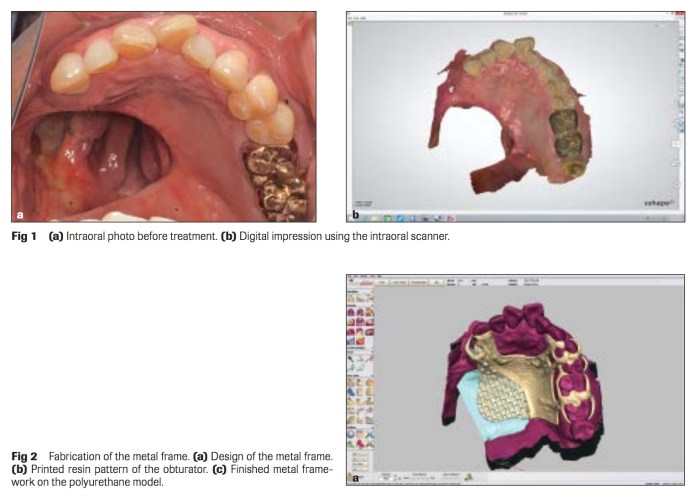Int J Prosthodont 2017 Vol.30-2