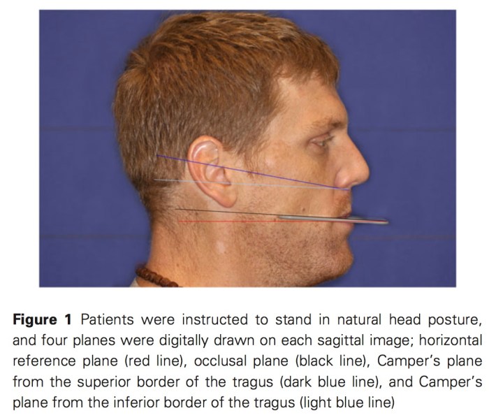 J Prosthodontics 2017 Vol.26-2