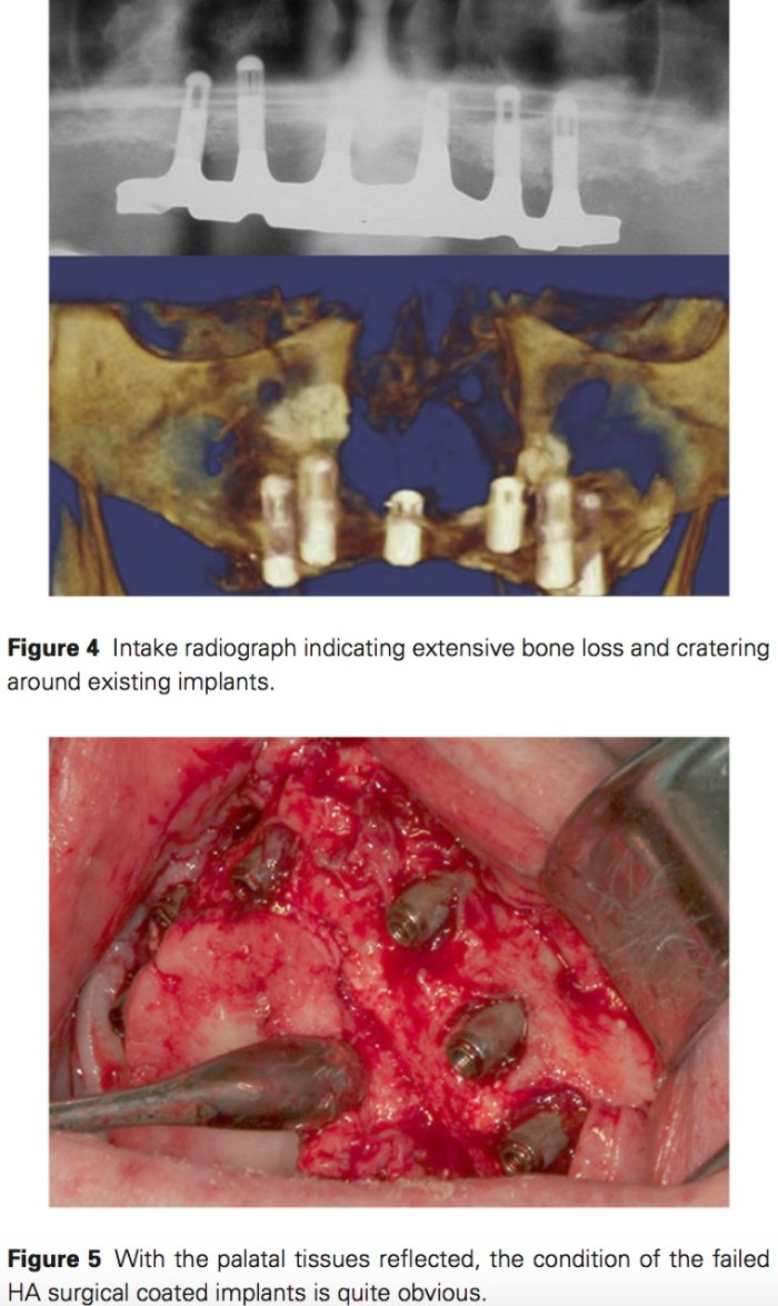 J Prosthodontics 2017 Vol.26-4