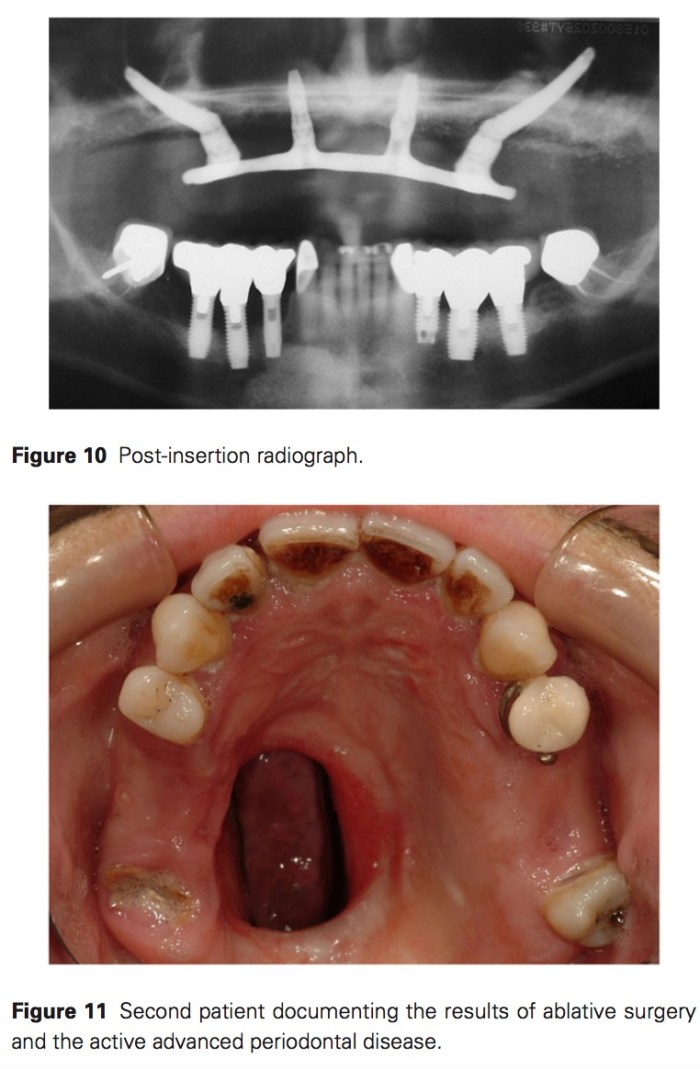 J prosthodontics 2017 Vol.26-8