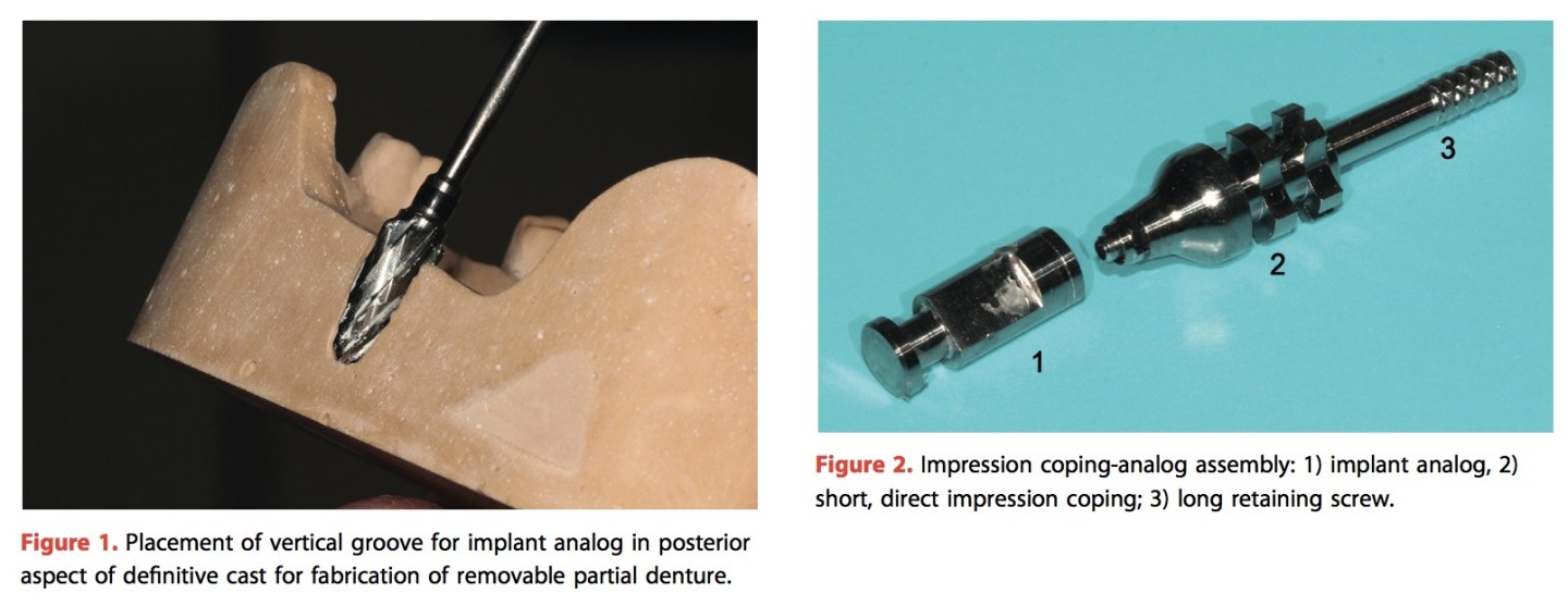 使用implant impression coping來重置和複製RPD cast—Lee(2018) | yehc